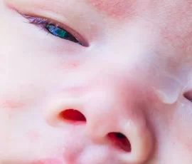 Bebeklerde Konjonktivit (Pembe Göz) Nedir? Belirtileri Nelerdir?